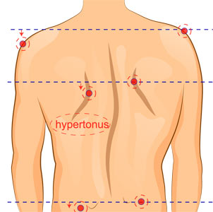 Asymetria postawy